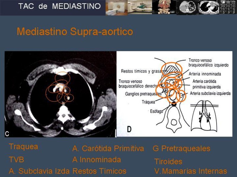 Diapositiva 10 de Imaginología Toráxica TAC