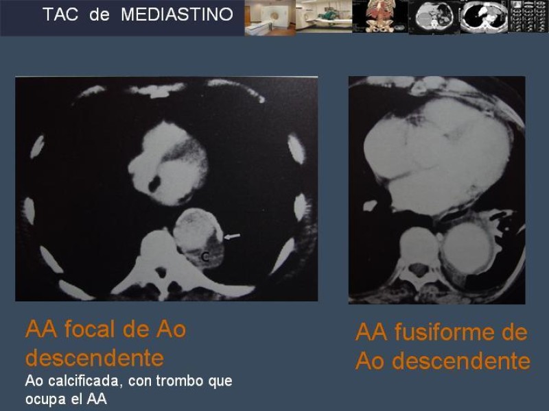 Diapositiva 26 de Imaginología Toráxica TAC