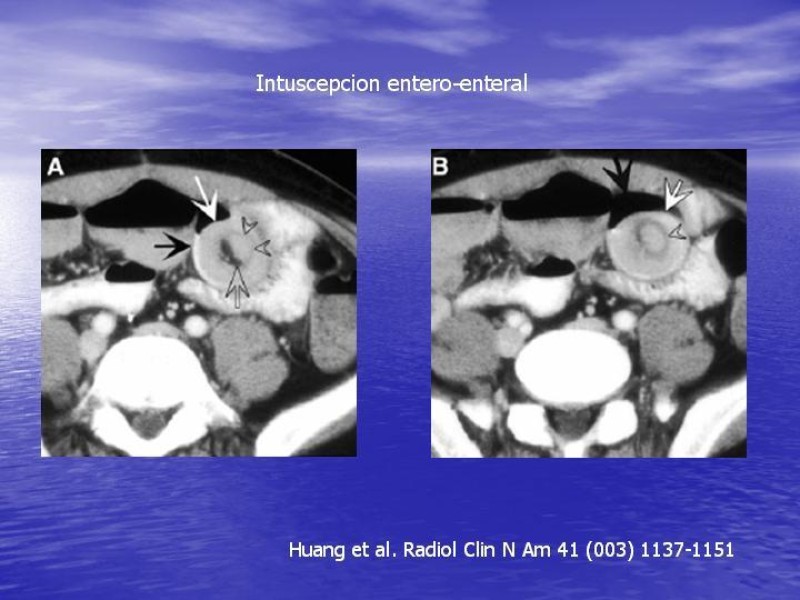 Diapositiva 21 de Obstrucción Intestinal: Estudio Diagnostico y Manejo inicial