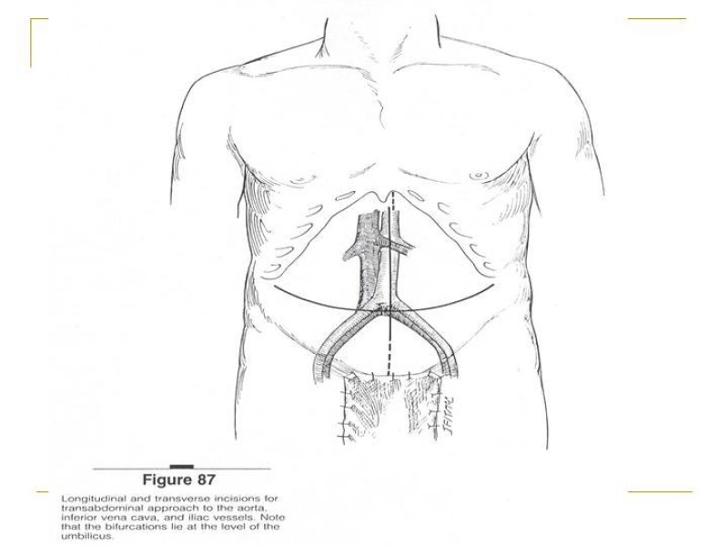 Diapositiva 9 de Accesos vasculares Abdominales