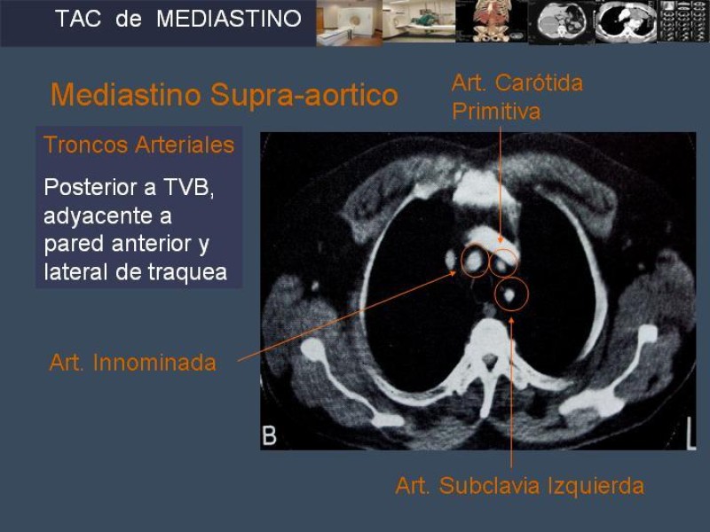 Diapositiva 9 de Imaginología Toráxica TAC