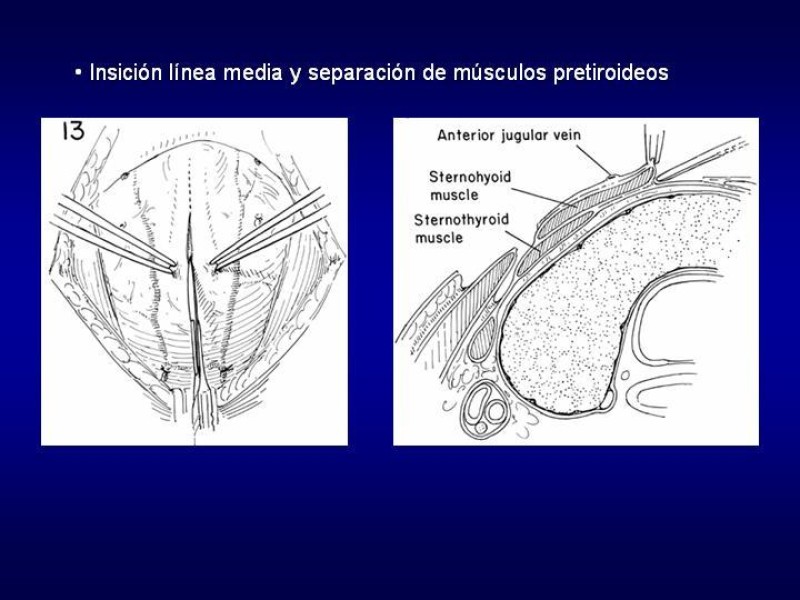 Diapositiva 16 de Tiroidectomía
