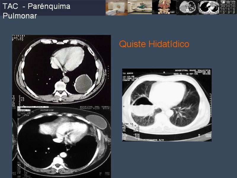 Diapositiva 64 de Imaginología Toráxica TAC
