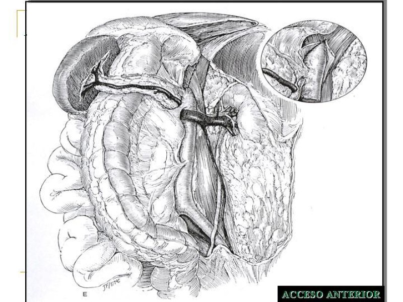 Diapositiva 29 de Accesos vasculares Abdominales