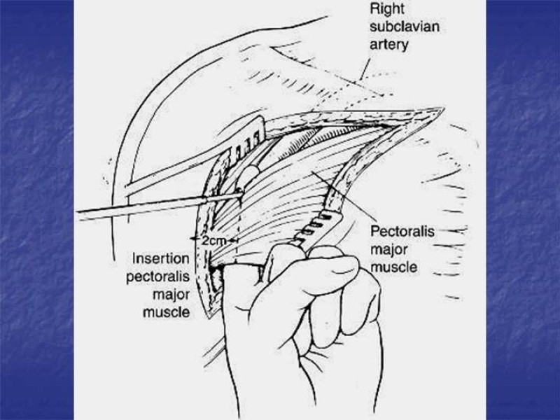 Diapositiva 58 de Abordaje Quirúrgico Vasculares