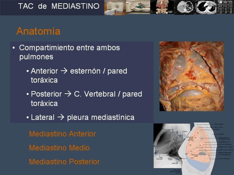 Diapositiva 4 de Imaginología Toráxica TAC