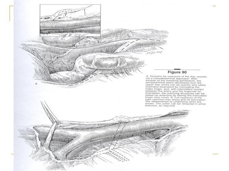 Diapositiva 55 de Accesos vasculares Abdominales