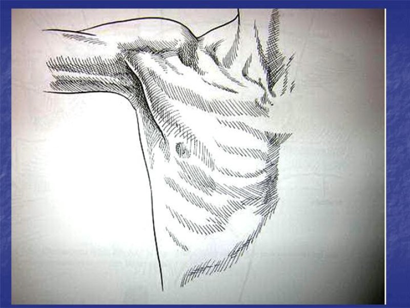 Diapositiva 55 de Abordaje Quirúrgico Vasculares