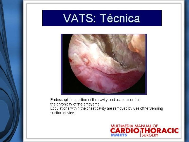 Diapositiva 29 de Empiema Pleural