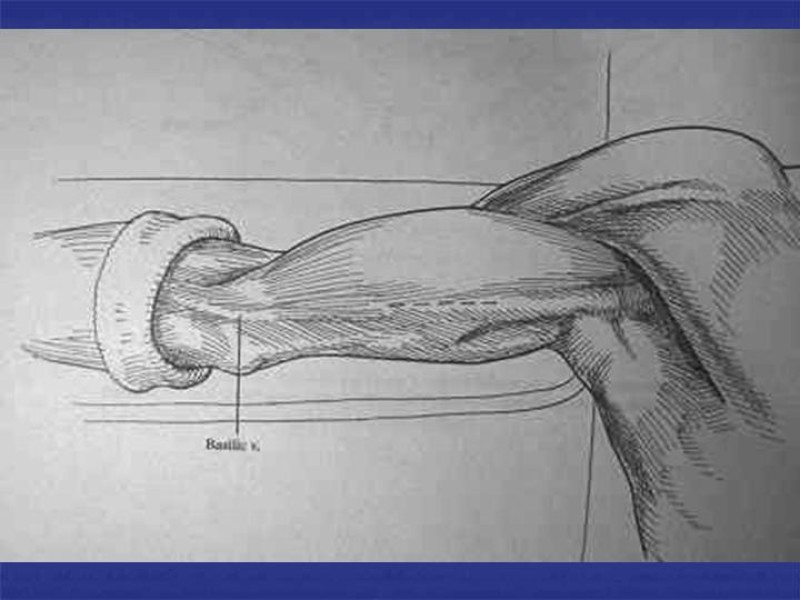 Diapositiva 66 de Abordaje Quirúrgico Vasculares