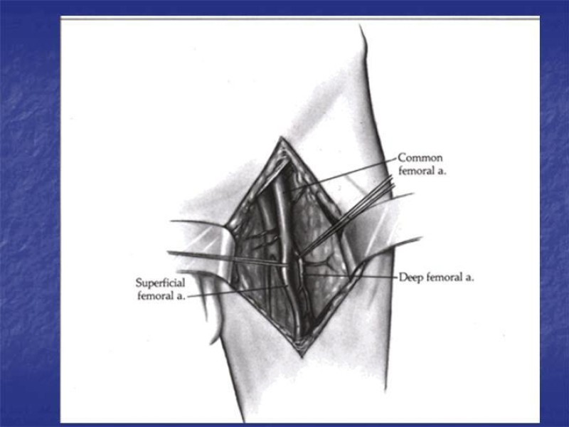 Diapositiva 94 de Abordaje Quirúrgico Vasculares