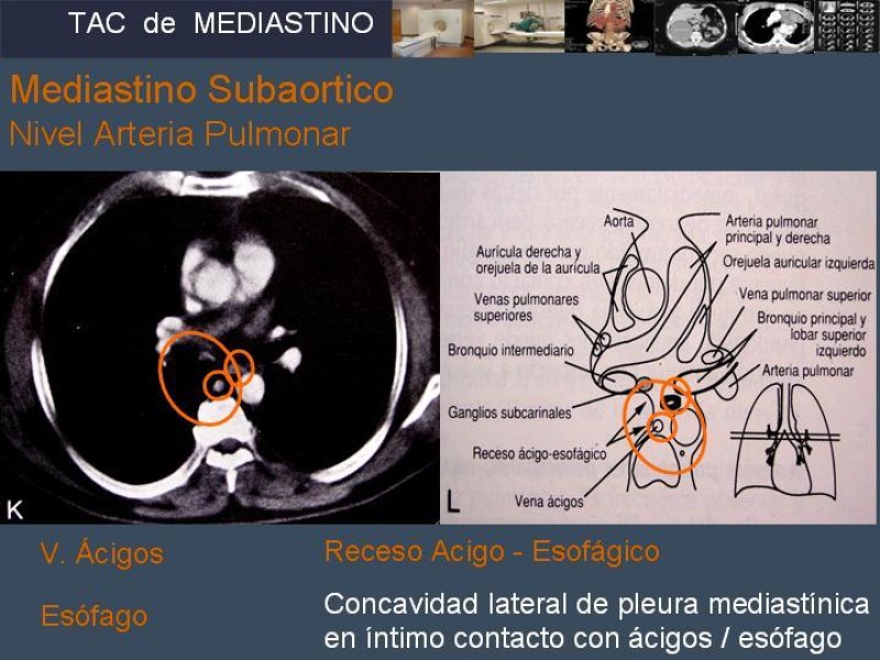 Diapositiva 19 de Imaginología Toráxica TAC