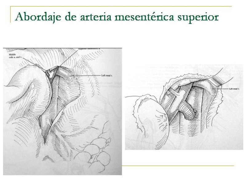 Diapositiva 76 de Accesos vasculares Abdominales