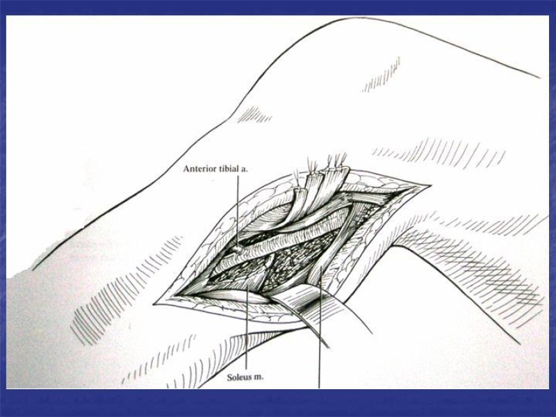 Diapositiva 113 de Abordaje Quirúrgico Vasculares