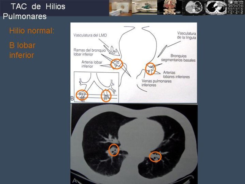 Diapositiva 55 de Imaginología Toráxica TAC