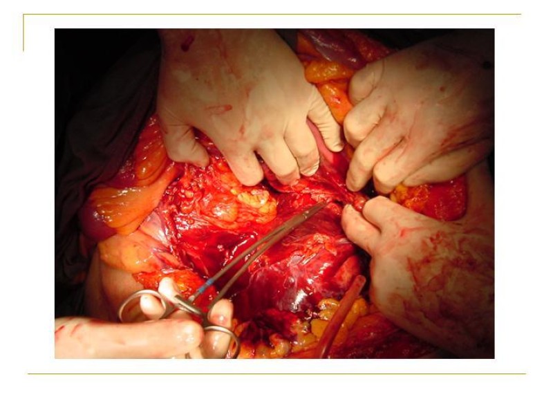 Diapositiva 24 de Accesos vasculares Abdominales