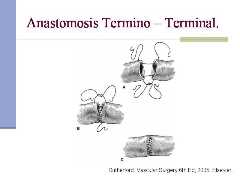 Diapositiva 21 de Reparación y Anastomosis Vasculares