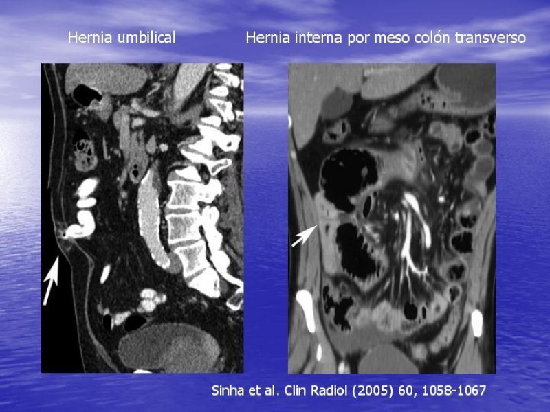 Diapositiva 19 de Obstrucción Intestinal: Estudio Diagnostico y Manejo inicial