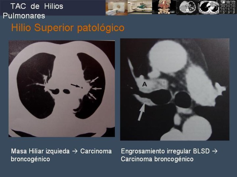 Diapositiva 49 de Imaginología Toráxica TAC