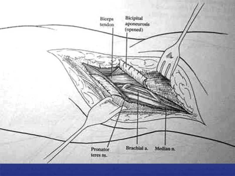 Diapositiva 75 de Abordaje Quirúrgico Vasculares