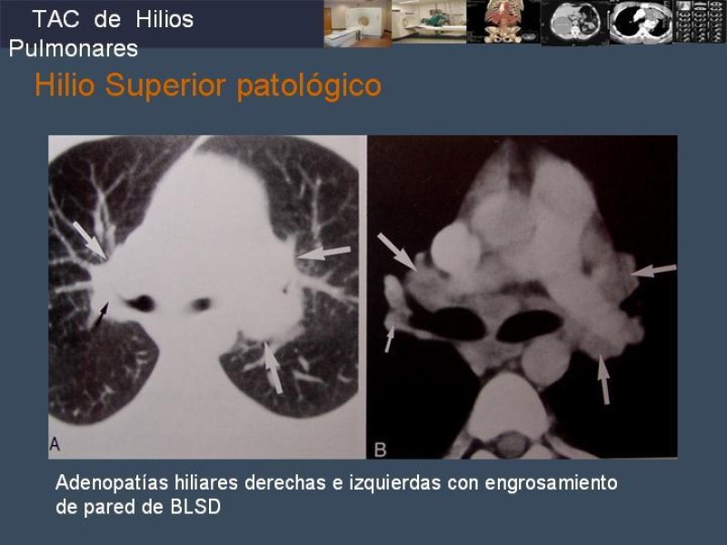 Diapositiva 48 de Imaginología Toráxica TAC