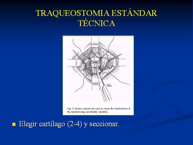 Diapositiva 13 de Traqueostomía Final