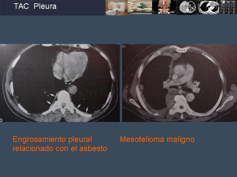 Diapositiva 69 de Imaginología Toráxica TAC