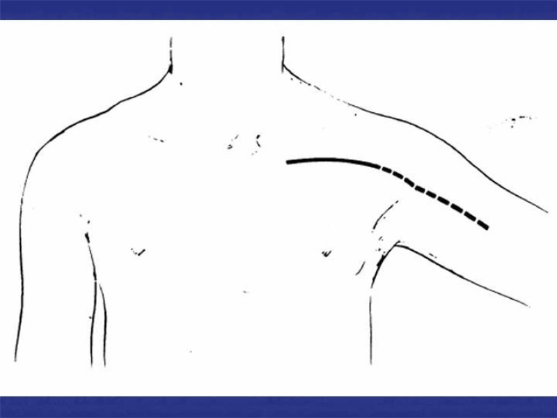 Diapositiva 56 de Abordaje Quirúrgico Vasculares