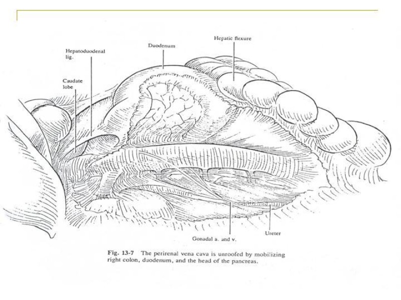 Diapositiva 94 de Accesos vasculares Abdominales