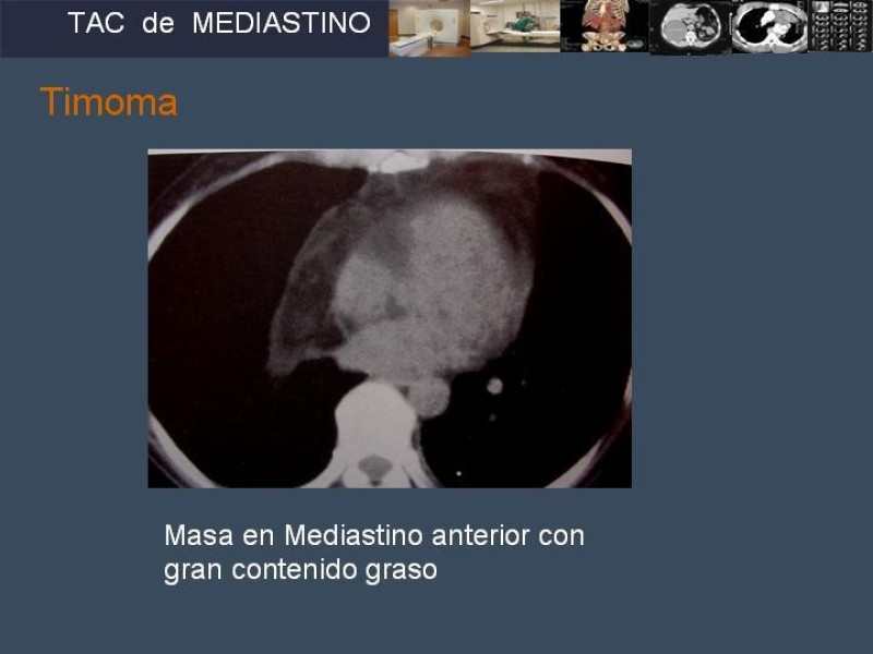 Diapositiva 37 de Imaginología Toráxica TAC