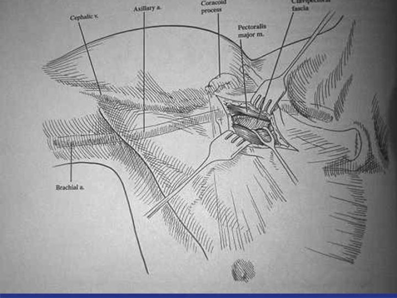 Diapositiva 57 de Abordaje Quirúrgico Vasculares