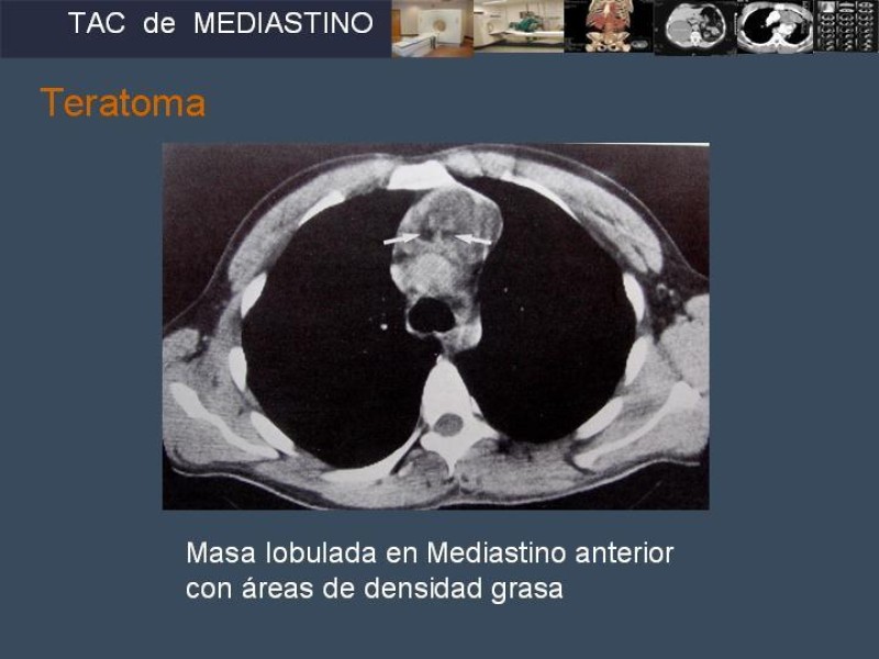 Diapositiva 38 de Imaginología Toráxica TAC