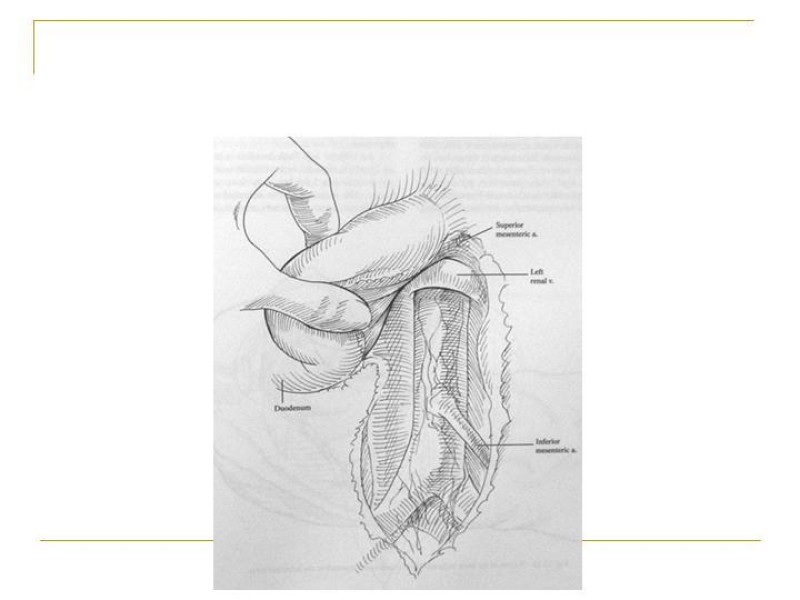 Diapositiva 50 de Accesos vasculares Abdominales