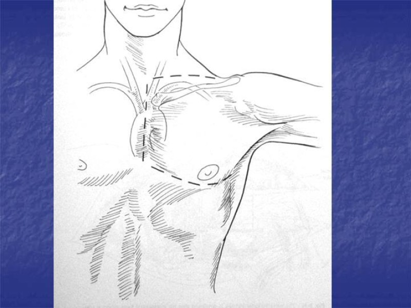 Diapositiva 47 de Abordaje Quirúrgico Vasculares