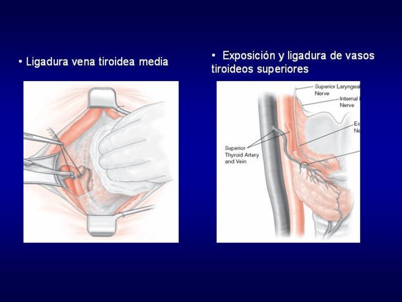 Diapositiva 17 de Tiroidectomía