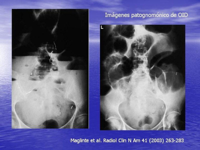 Diapositiva 13 de Obstrucción Intestinal: Estudio Diagnostico y Manejo inicial