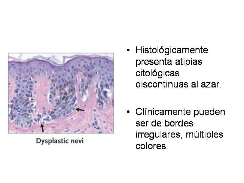 Diapositiva 10 de Melanoma