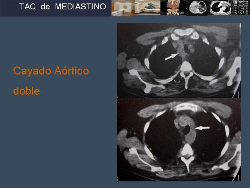 Diapositiva 24 de Imaginología Toráxica TAC