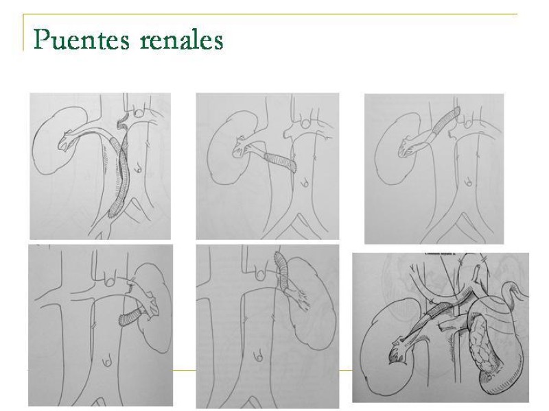 Diapositiva 91 de Accesos vasculares Abdominales