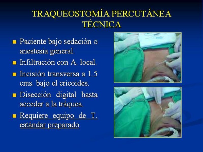 Diapositiva 24 de Traqueostomía Final
