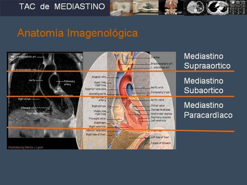 Diapositiva 5 de Imaginología Toráxica TAC