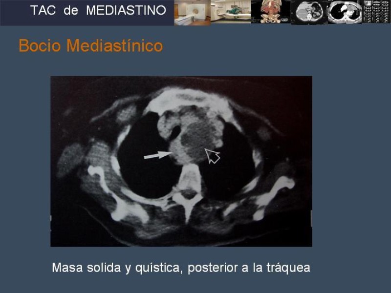 Diapositiva 39 de Imaginología Toráxica TAC