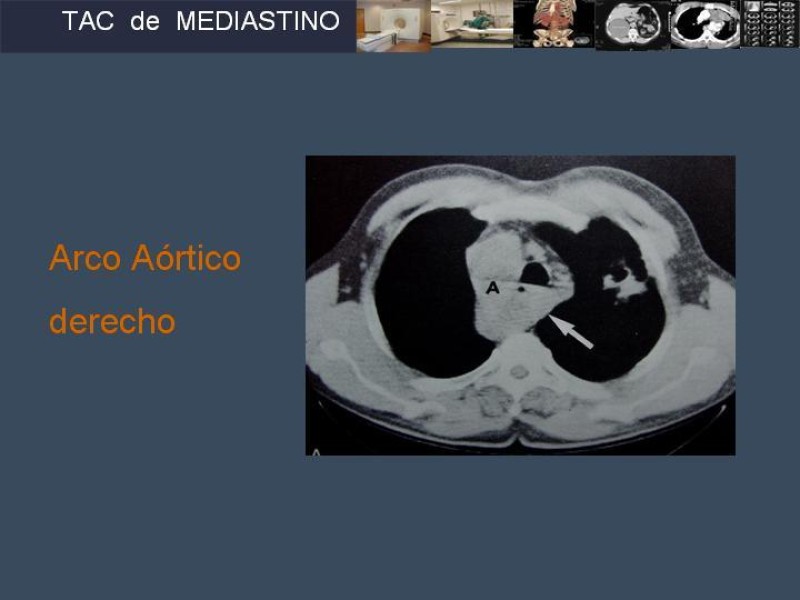 Diapositiva 23 de Imaginología Toráxica TAC
