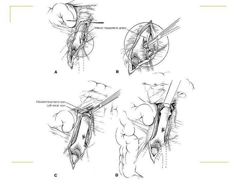 Diapositiva 21 de Accesos vasculares Abdominales