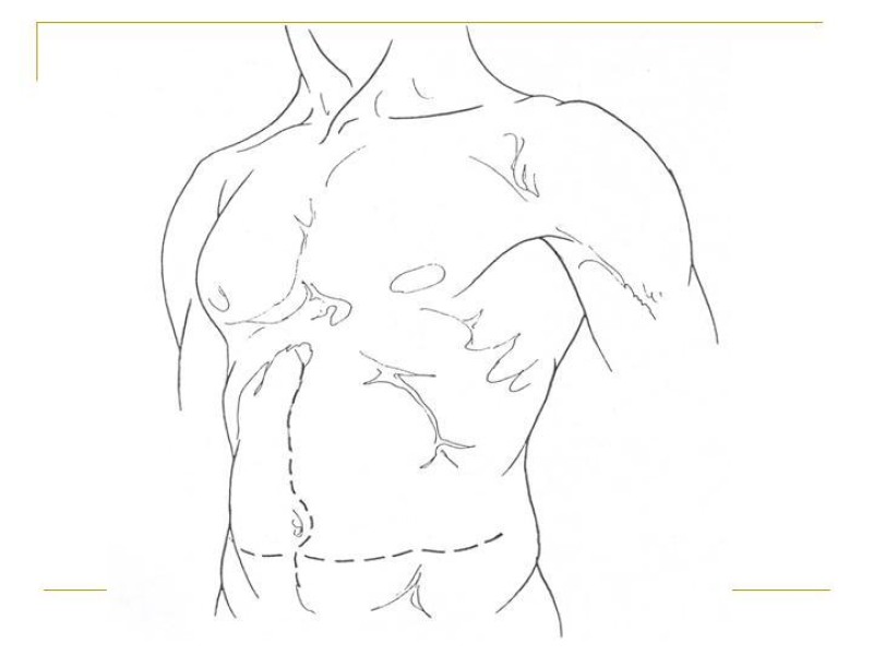 Diapositiva 12 de Accesos vasculares Abdominales