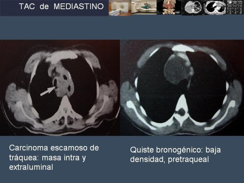 Diapositiva 40 de Imaginología Toráxica TAC
