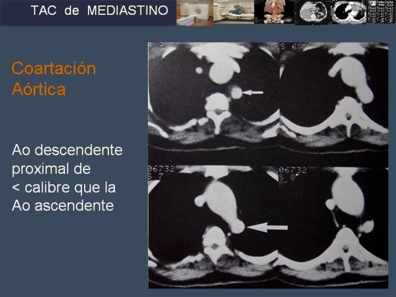 Diapositiva 25 de Imaginología Toráxica TAC