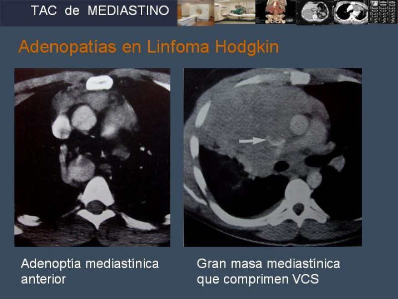 Diapositiva 33 de Imaginología Toráxica TAC