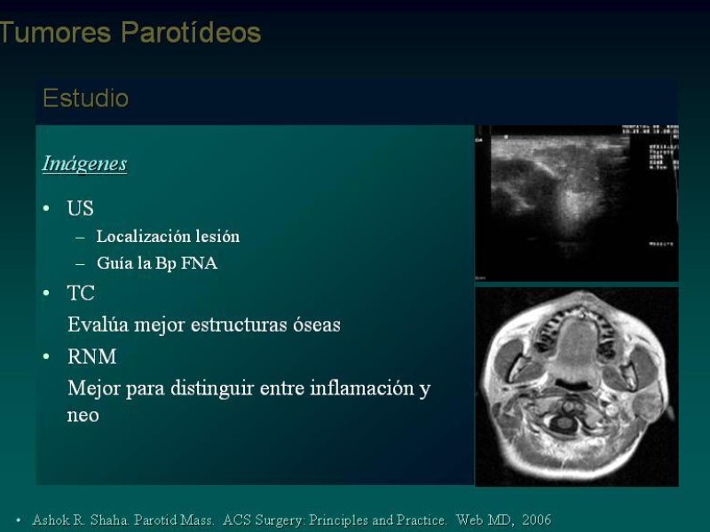Diapositiva 16 de Masas Parotídeas