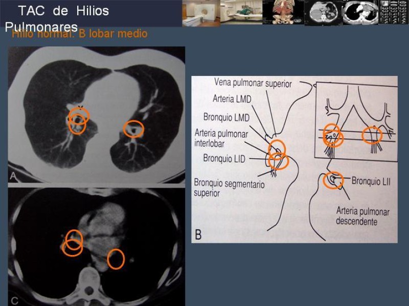 Diapositiva 54 de Imaginología Toráxica TAC